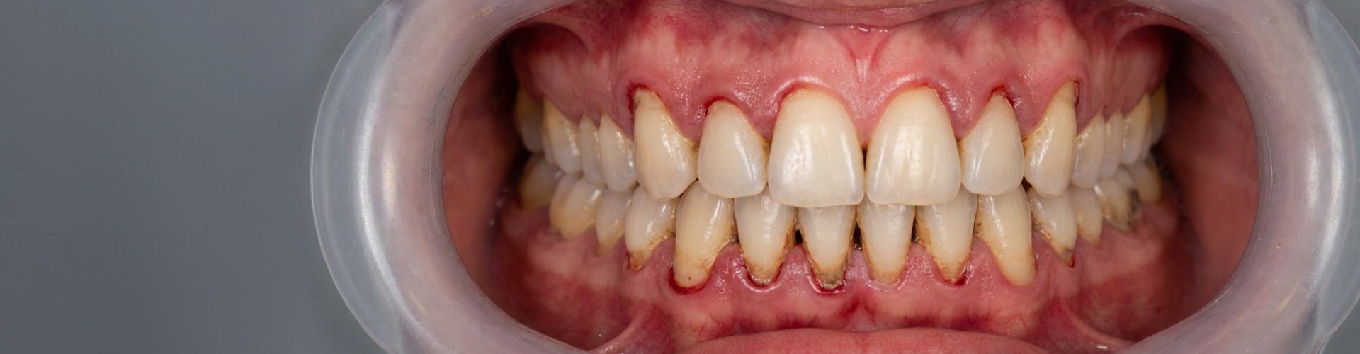 Close-up of teeth with gum recession, exposed roots, and visible tartar buildup.